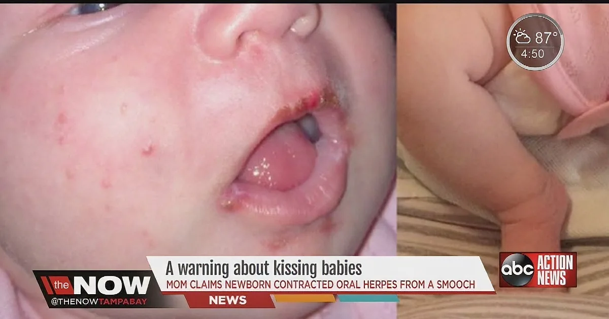 A baby with visible oral herpes on the lips, shown in a news broadcast.