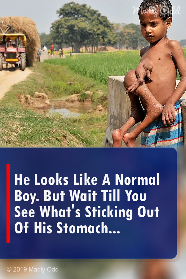 He Looks Like A Normal Boy. But Wait Till You See What\'s Sticking Out Of His Stomach...